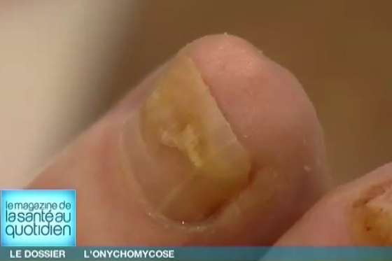 Onychomycose