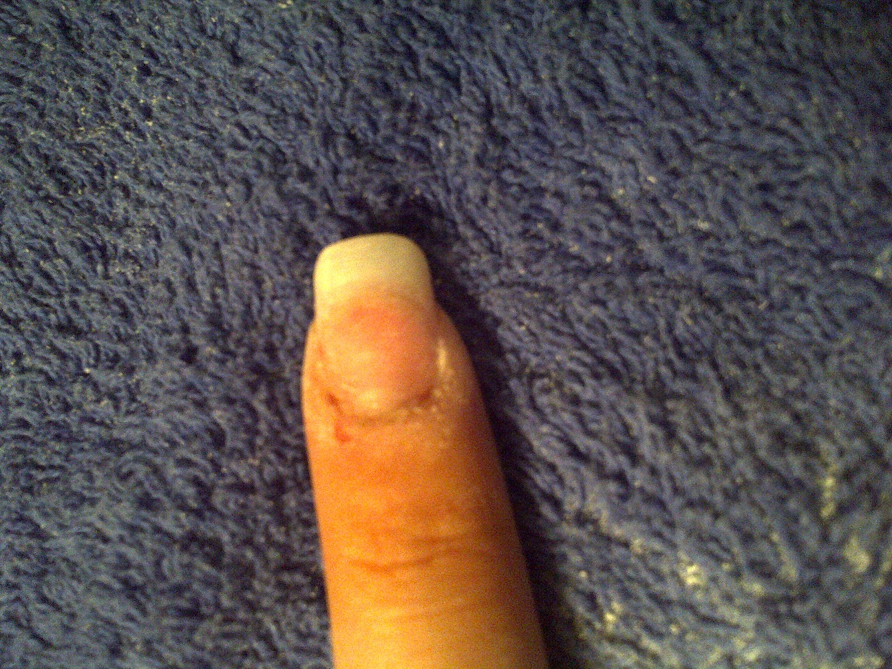 prise de forme et limage de la capsule